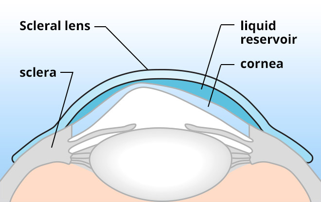scleral lens diagram 660x416
